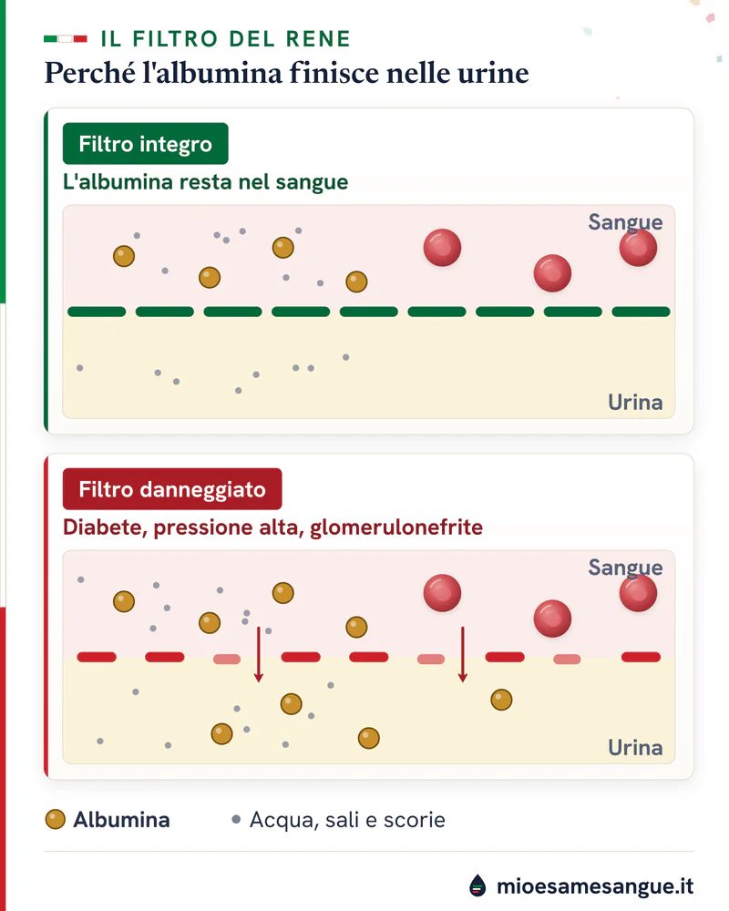 Glomerulo integro che trattiene l'albumina nel sangue e glomerulo danneggiato che la lascia passare nelle urine