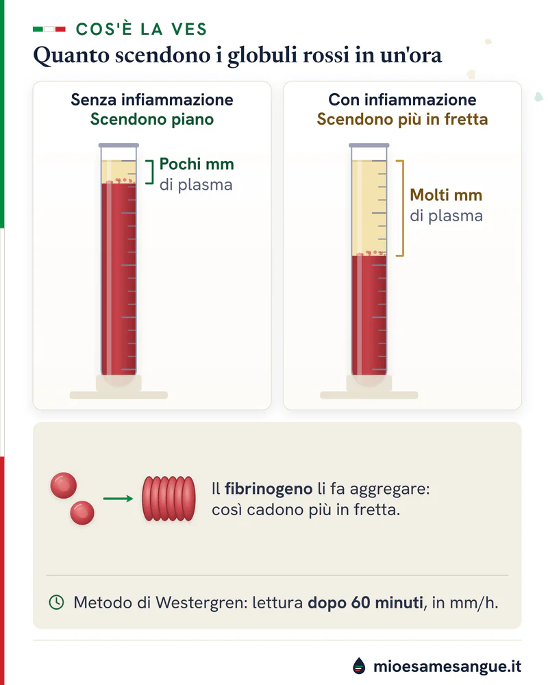 Due provette della VES dopo 60 minuti: colonna rossa poco scesa senza infiammazione, molto scesa con globuli rossi aggregati